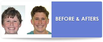 before and after braces photos