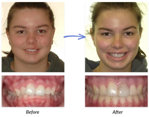 Surgery Before After Delurgio Orthodontics Delurgio Orthodontics