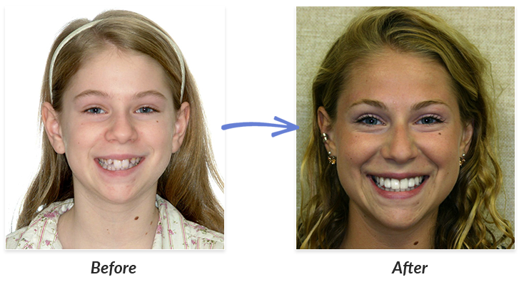 Before & After Braces Photos  DeLurgio Orthodontics : DeLurgio Orthodontics