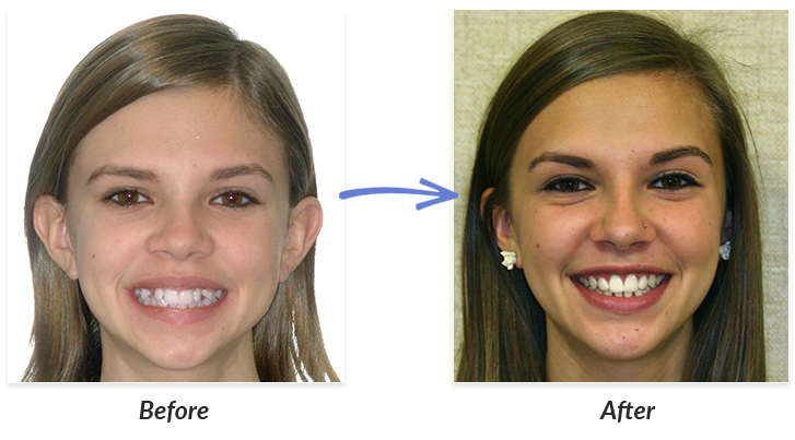 Before And After Braces Photos Delurgio Orthodontics Delurgio