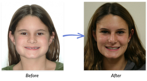 Before And After Braces Photo