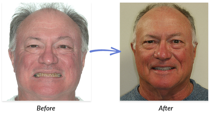 Before & After Braces Photos | DeLurgio Orthodontics : DeLurgio