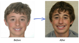 Before And After Braces Photo