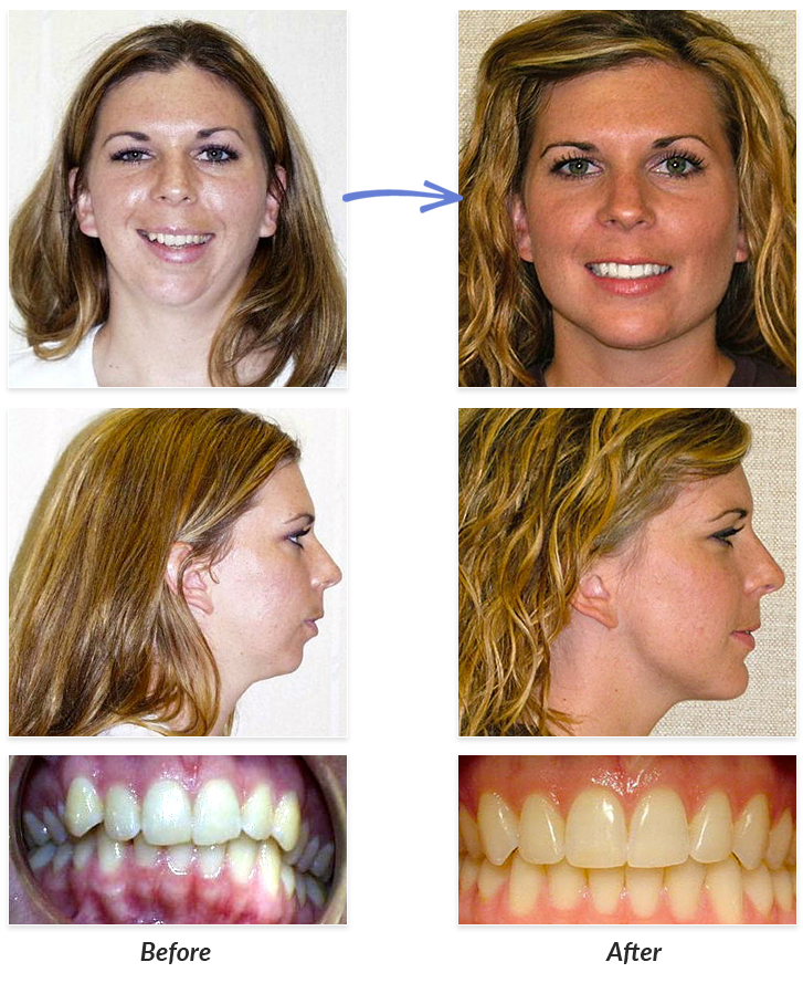 Before & After Braces Photos  DeLurgio Orthodontics : DeLurgio Orthodontics
