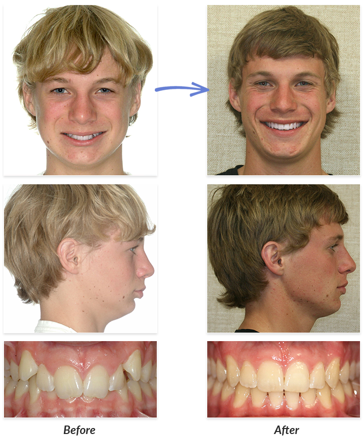 braces journey before and after